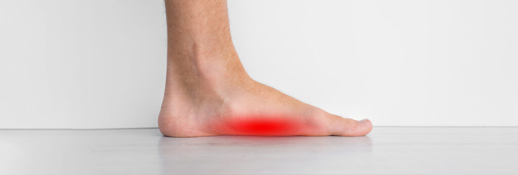 Side view of a low foot arch with the arch-pain area highlighted